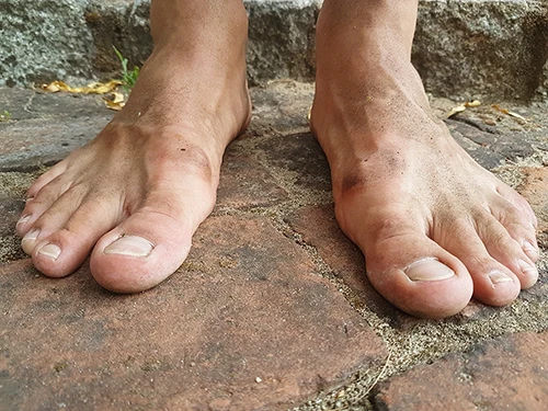 Does Diabetes Make Your Feet Itch?