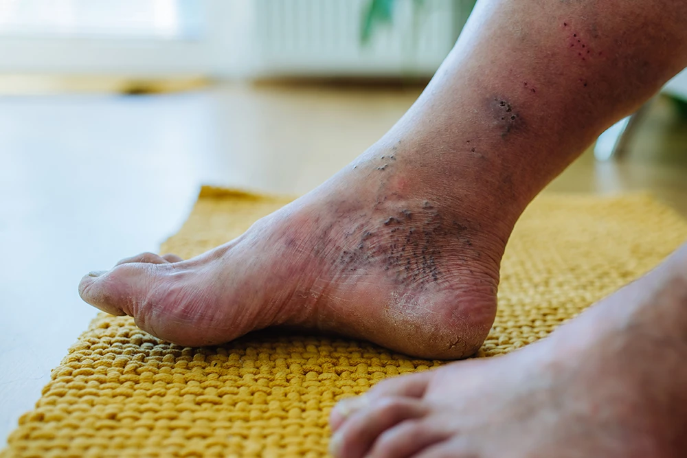 What Causes Chronic Venous Insufficiency?