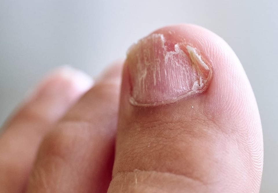Best Way to Remove Fungus From Toenail