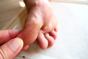 Are Plantar Warts on Feet Contagious?