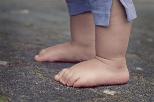 Pediatric Flatfoot Deformity and Its Treatment