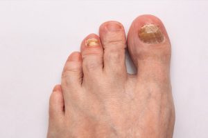 What are Toenail Fungus Thick Nails?