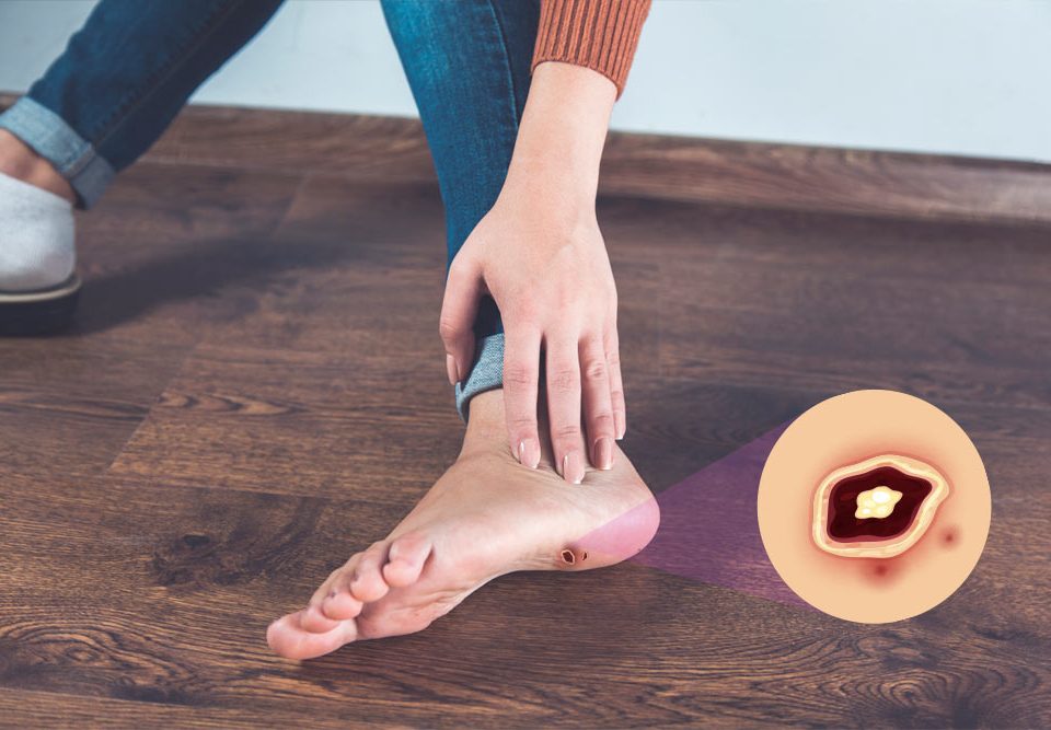 What is the Best Dressing for Diabetic Foot Ulcers?