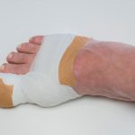 5 Signs of Infection After Toenail Removal Surgery