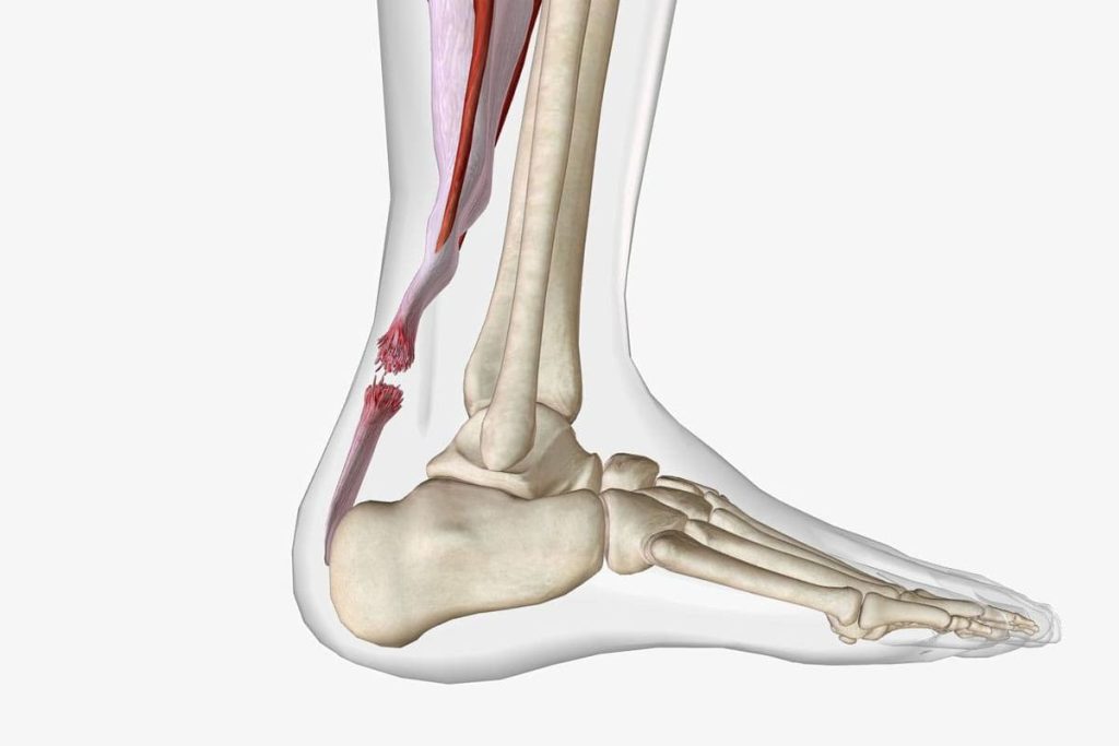 Achilles Tendonitis Treatment Scottsdale