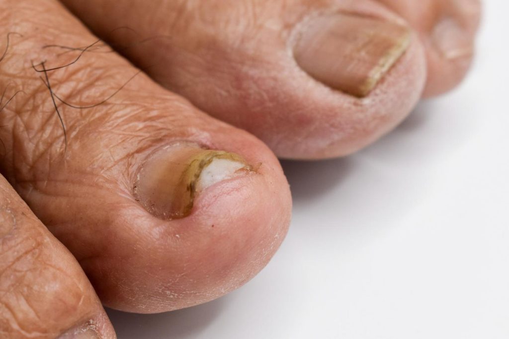 Advanced Nail Fungus Treatments Chandler