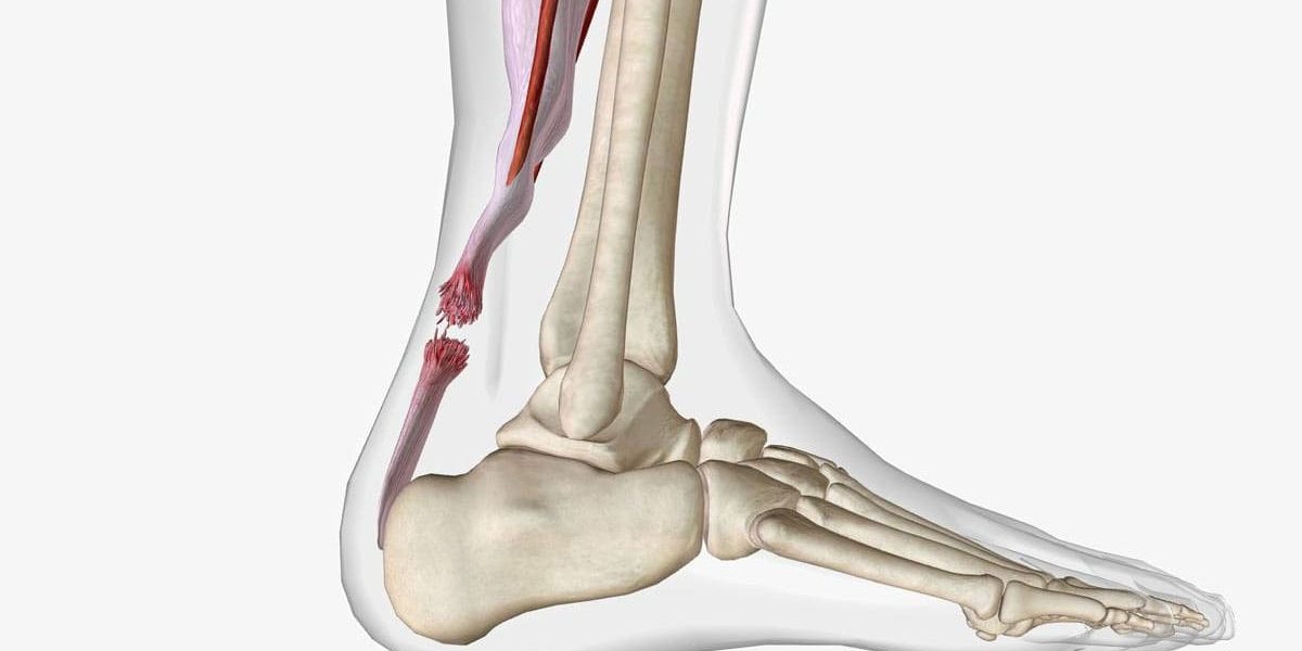 Achilles Tendonitis Treatment Gilbert